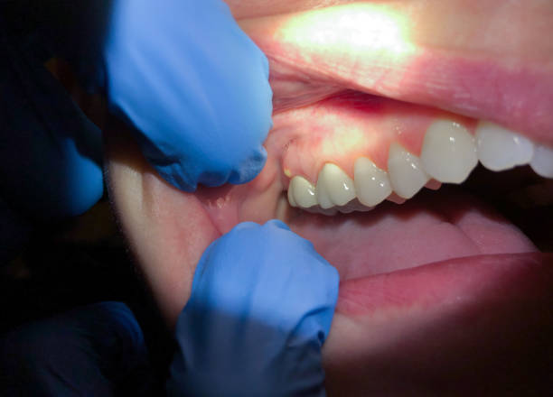 Best Emergency Root Canal Treatment in Escanaba, MI